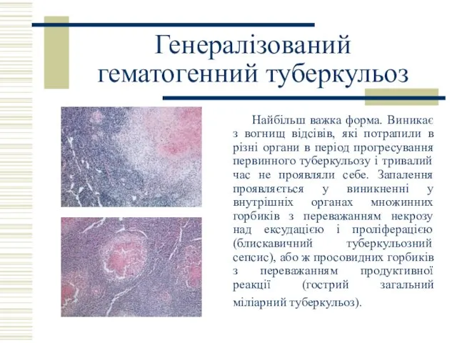 Генералізований гематогенний туберкульоз Найбільш важка форма. Виникає з вогнищ відсівів,