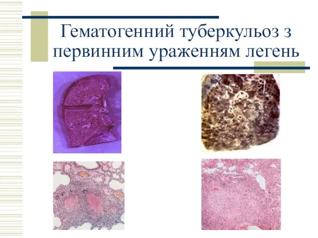 Гематогенний туберкульоз з первинним ураженням легень