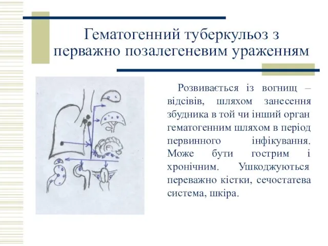 Гематогенний туберкульоз з перважно позалегеневим ураженням Розвивається із вогнищ –