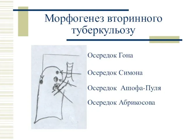 Морфогенез вторинного туберкульозу Осередок Гона Осередок Симона Осередок Ашофа-Пуля Осередок Абрикосова