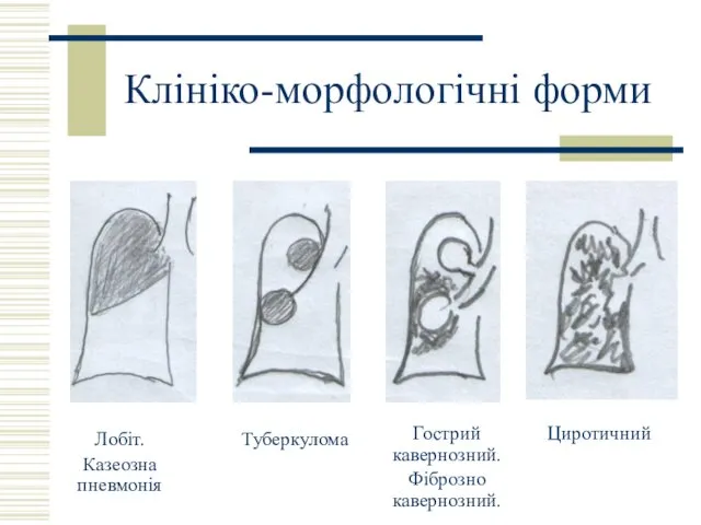 Клініко-морфологічні форми Лобіт. Казеозна пневмонія Туберкулома Циротичний Гострий кавернозний. Фіброзно кавернозний.