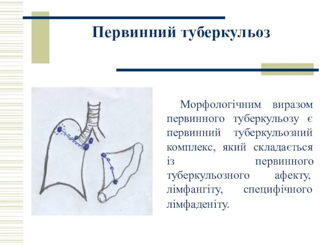 Первинний туберкульоз Морфологічним виразом первинного туберкульозу є первинний туберкульозний комплекс, який складається із