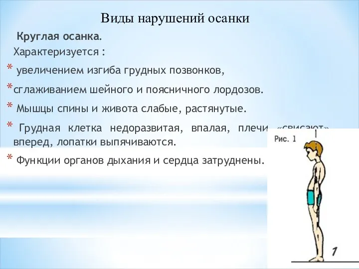 Круглая осанка. Характеризуется : увеличением изгиба грудных позвонков, сглаживанием шейного