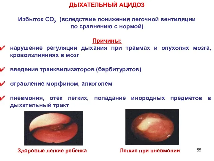 ДЫХАТЕЛЬНЫЙ АЦИДОЗ Избыток СО2 (вследствие понижения легочной вентиляции по сравнению