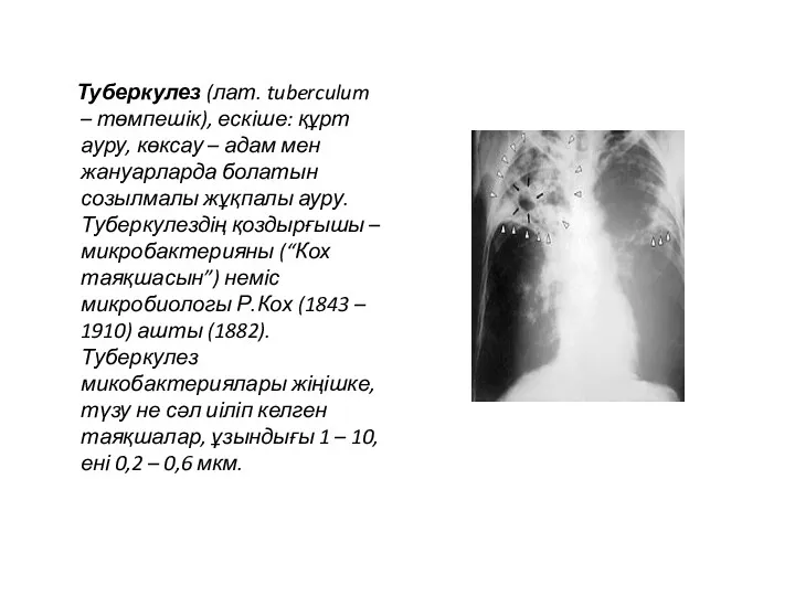 Туберкулез (лат. tuberculum – төмпешік), ескіше: құрт ауру, көксау –