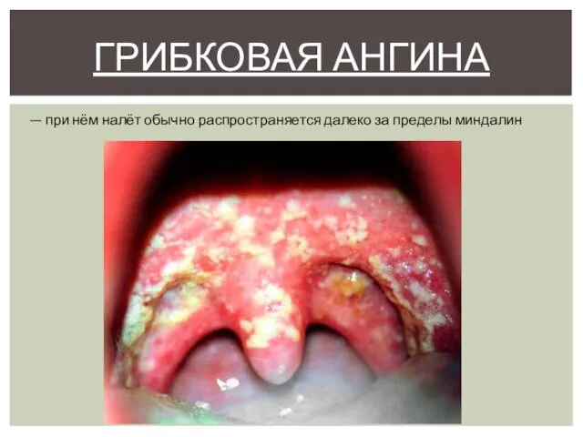 ГРИБКОВАЯ АНГИНА — при нём налёт обычно распространяется далеко за пределы миндалин