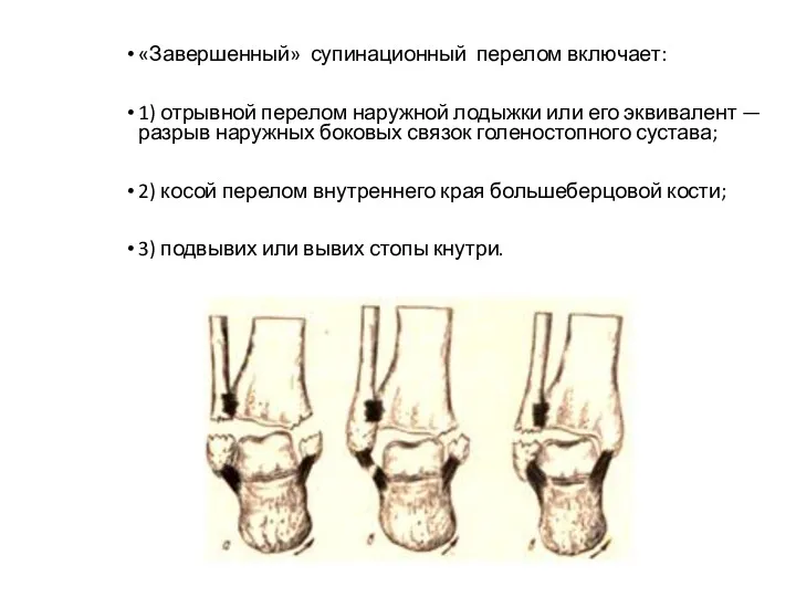 «Завершенный» супинационный перелом включает: 1) отрывной перелом наружной лодыжки или его эквивалент —