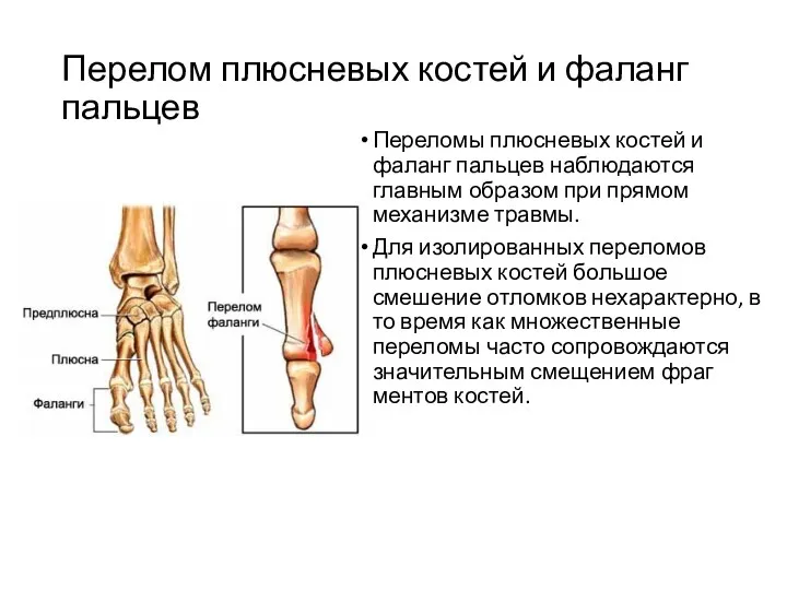 Перелом плюсневых костей и фаланг пальцев Переломы плюсневых костей и фаланг пальцев наблюдаются