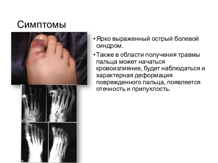 Симптомы Ярко выраженный острый болевой синдром. Также в области получения травмы пальца может