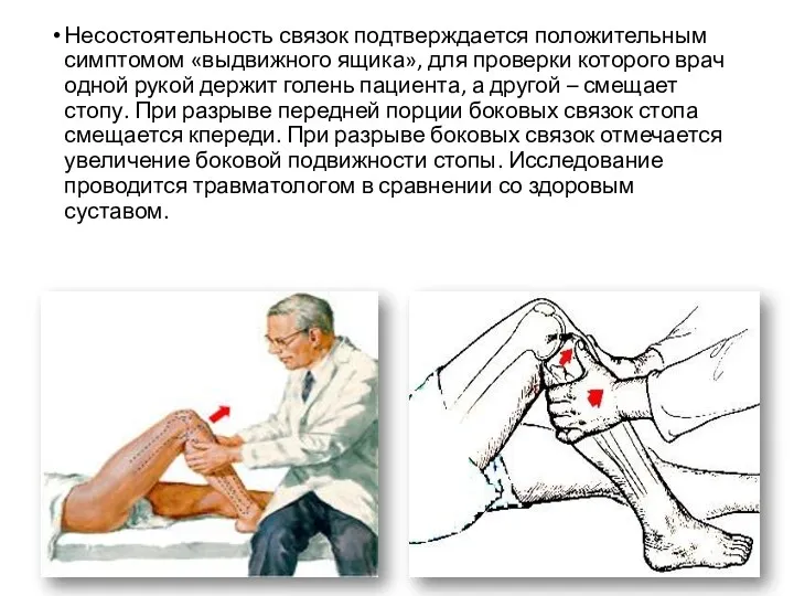 Несостоятельность связок подтверждается положительным симптомом «выдвижного ящика», для проверки которого врач одной рукой