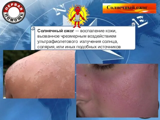 Солнечный ожог Солнечный ожог — воспаление кожи, вызванное чрезмерным воздействием