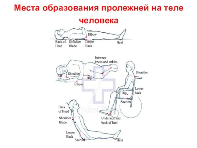 Места образования пролежней на теле человека