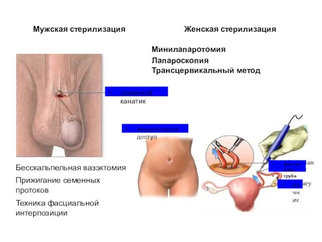 Минилапаротомия Лапароскопия Трансцервикальный метод Женская стерилизация Мужская стерилизация Бесскальпельная вазэктомия Прижигание семенных протоков Техника фасциальной интерпозиции