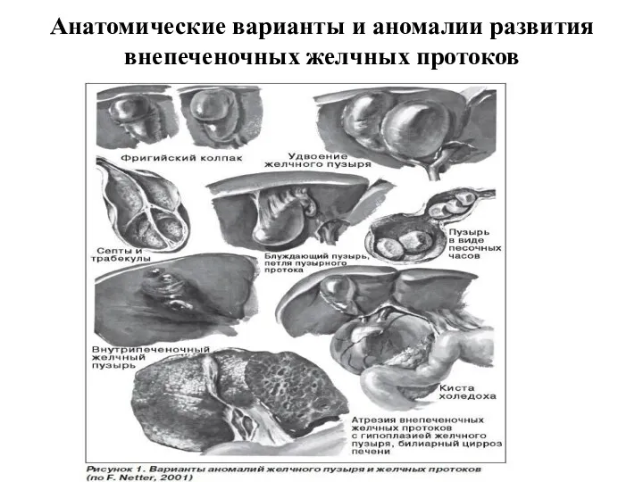 Анатомические варианты и аномалии развития внепеченочных желчных протоков