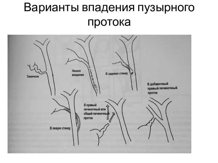 Варианты впадения пузырного протока