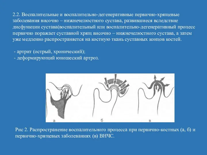 2.2. Воспалительные и воспалительно-дегенеративные первично-хрящевые заболевания височно – нижнечелюстного сустава,