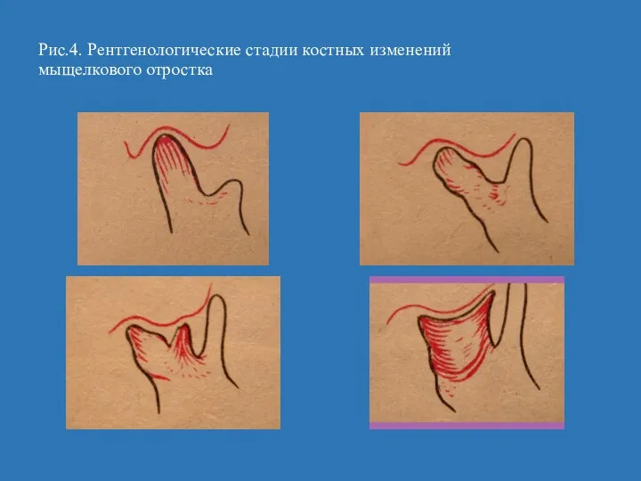 Рис.4. Рентгенологические стадии костных изменений мыщелкового отростка