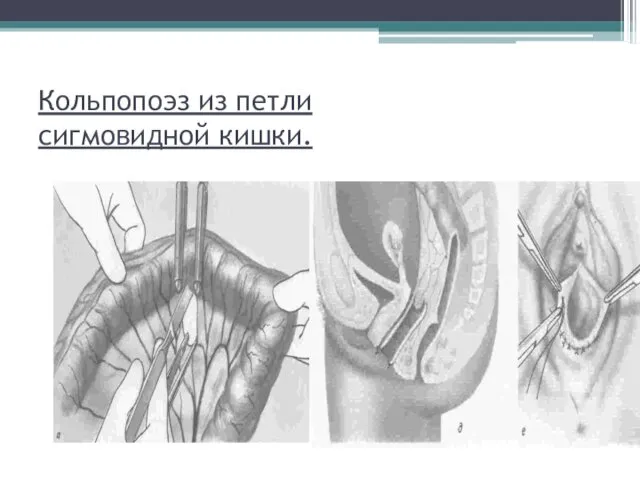 Кольпопоэз из петли сигмовидной кишки.