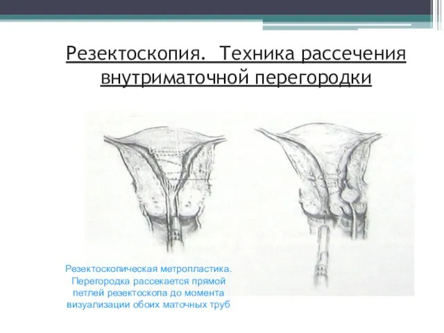 Резектоскопия. Техника рассечения внутриматочной перегородки Резектоскопическая метропластика. Перегородка рассекается прямой петлей резектоскопа до