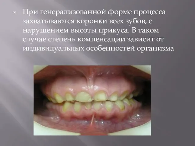 При генерализованной форме процесса захватываются коронки всех зубов, с нарушением