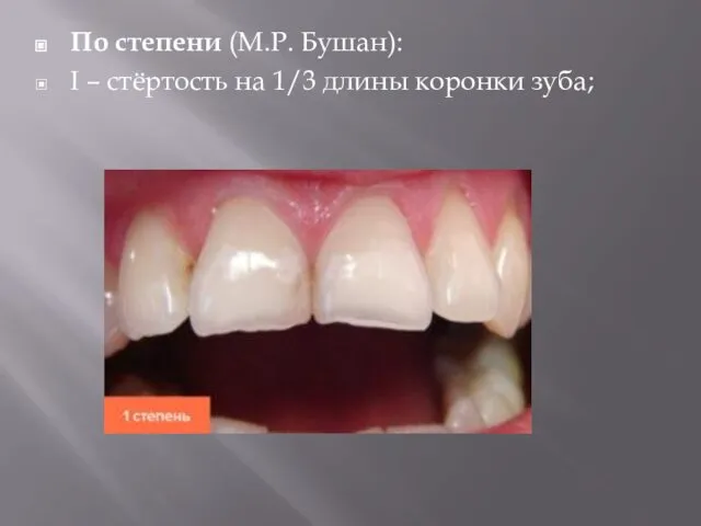 По степени (М.Р. Бушан): I – стёртость на 1/3 длины коронки зуба;