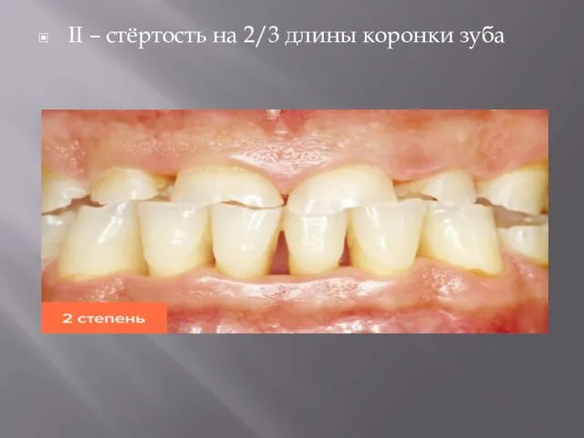 II – стёртость на 2/3 длины коронки зуба