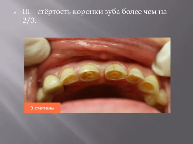 III – стёртость коронки зуба более чем на 2/3.