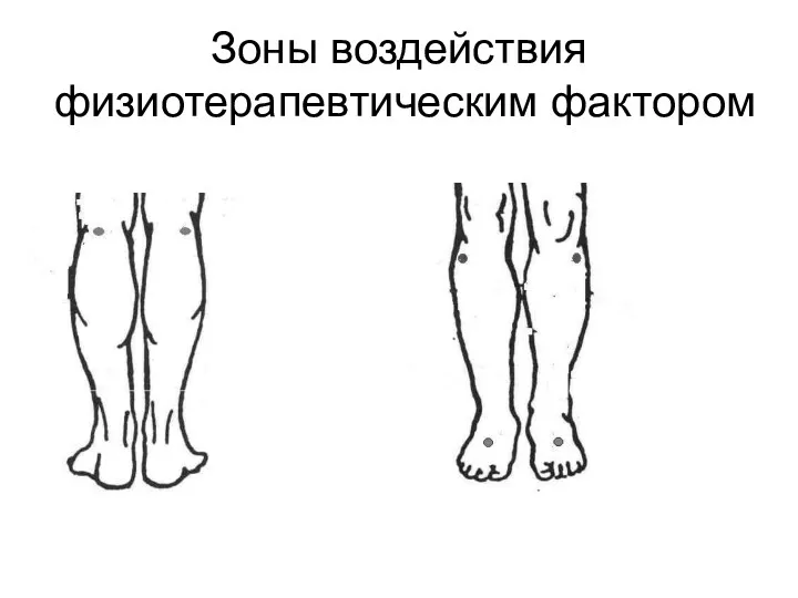 Зоны воздействия физиотерапевтическим фактором