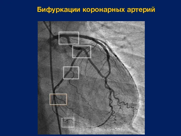 Бифуркации коронарных артерий