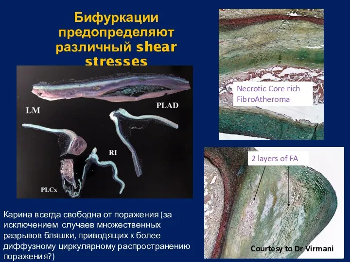 Courtesy to Dr Virmani Бифуркации предопределяют различный shear stresses Necrotic