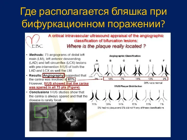 Где располагается бляшка при бифуркационном поражении?