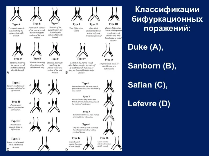 Классификации бифуркационных поражений: Duke (A), Sanborn (B), Safian (C), Lefevre (D)
