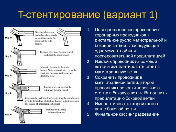 T-стентирование (вариант 1) Последовательное проведение коронарных проводников в дистальное русло