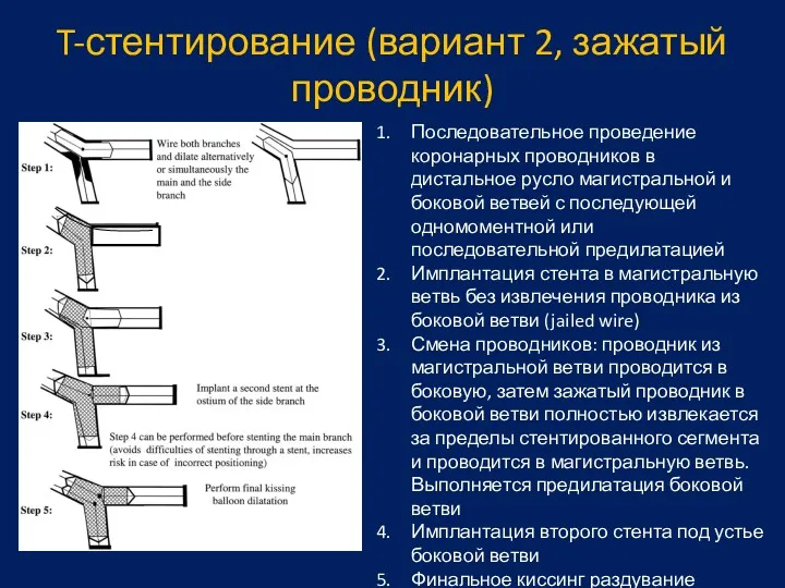 T-стентирование (вариант 2, зажатый проводник) Последовательное проведение коронарных проводников в