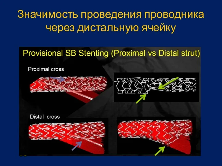 Значимость проведения проводника через дистальную ячейку