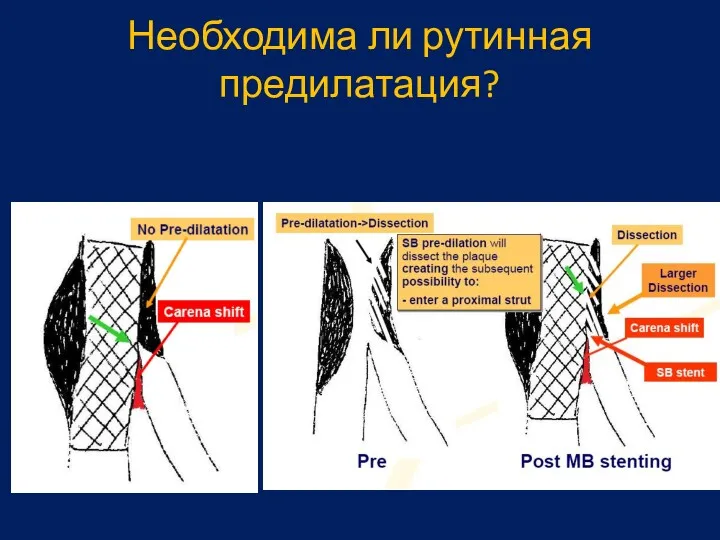 Необходима ли рутинная предилатация?