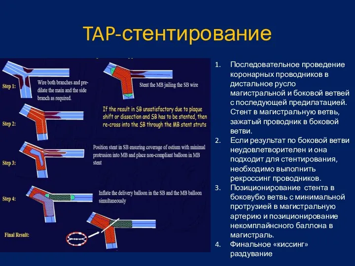 TAP-стентирование Последовательное проведение коронарных проводников в дистальное русло магистральной и