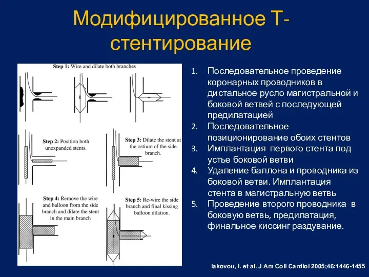 Модифицированное Т-стентирование Iakovou, I. et al. J Am Coll Cardiol