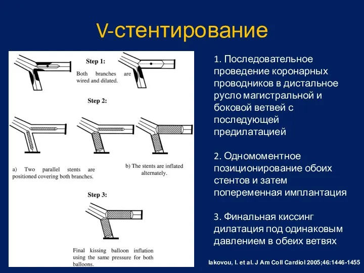 V-стентирование Iakovou, I. et al. J Am Coll Cardiol 2005;46:1446-1455