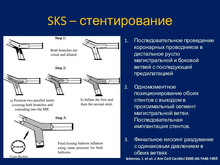 SKS – стентирование Iakovou, I. et al. J Am Coll