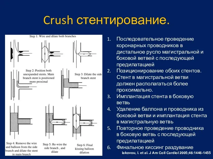 Crush стентирование. Iakovou, I. et al. J Am Coll Cardiol