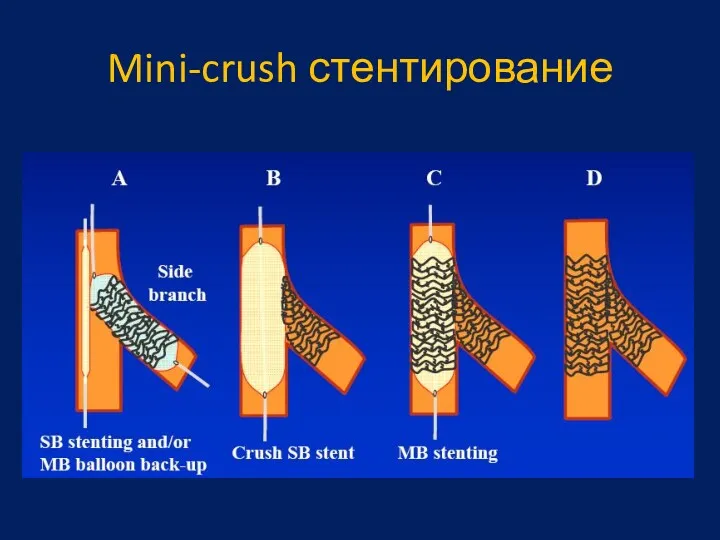 Mini-crush стентирование