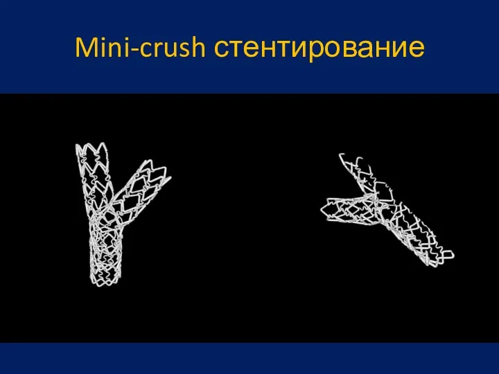 Mini-crush стентирование