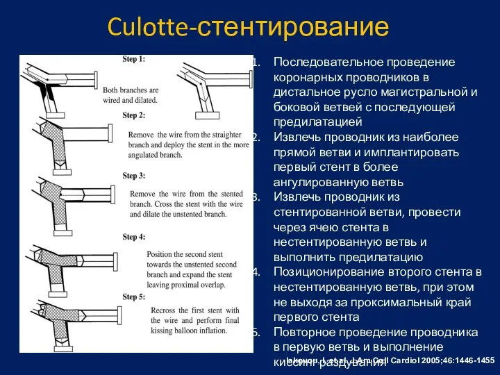 Culotte-стентирование Iakovou, I. et al. J Am Coll Cardiol 2005;46:1446-1455