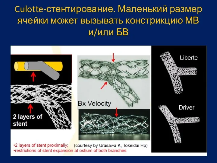Culotte-стентирование. Маленький размер ячейки может вызывать констрикцию МВ и/или БВ