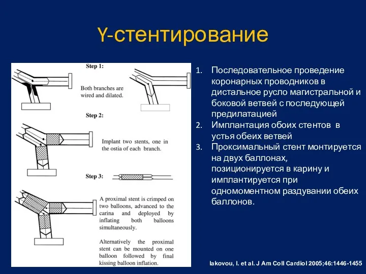 Y-стентирование Iakovou, I. et al. J Am Coll Cardiol 2005;46:1446-1455