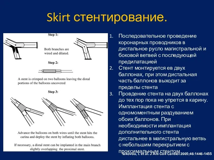 Skirt стентирование. Iakovou, I. et al. J Am Coll Cardiol