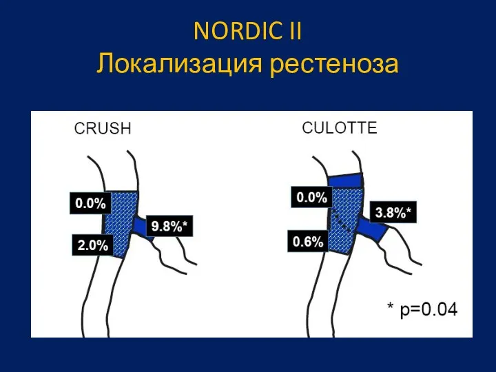 NORDIC II Локализация рестеноза