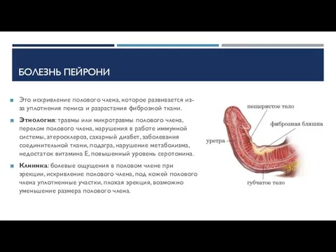 БОЛЕЗНЬ ПЕЙРОНИ Это искривление полового члена, которое развивается из-за уплотнения