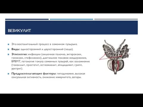 ВЕЗИКУЛИТ Это воспалительный процесс в семенном пузырьке. Виды: односторонний и